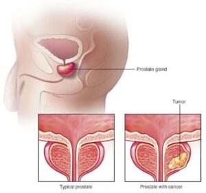 prostate-issues-sperm-cramps