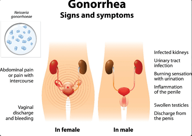 gonorrhea-blue-waffle