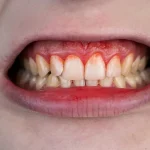 How Oral Bacteria Impacts Your Cardiovascular Health?