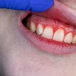 Why Bleeding Gums Shouldn’t Be Ignored?