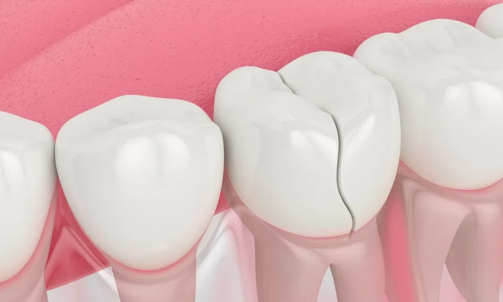 What Is Tooth Enamel?
