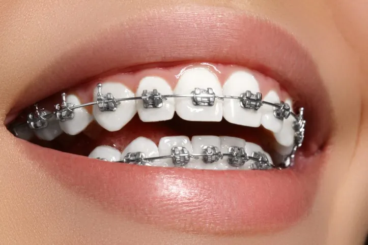 The top reasons why Invisalign is a popular orthodontic treatment